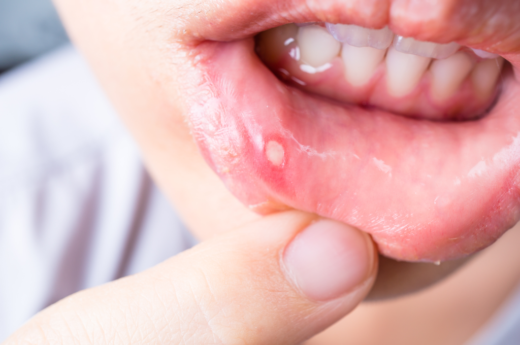 Mouth Sores Woodridge Clinic