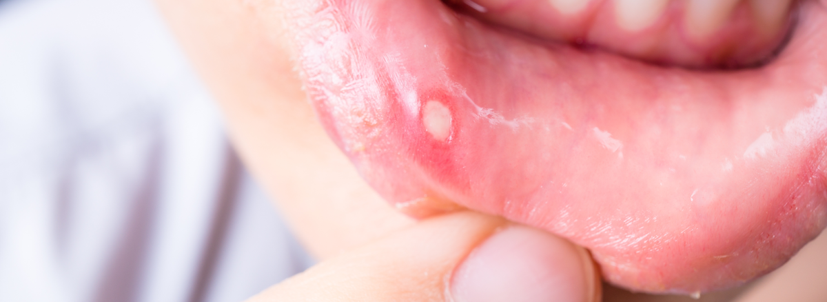 mouth-sores-woodridge-clinic