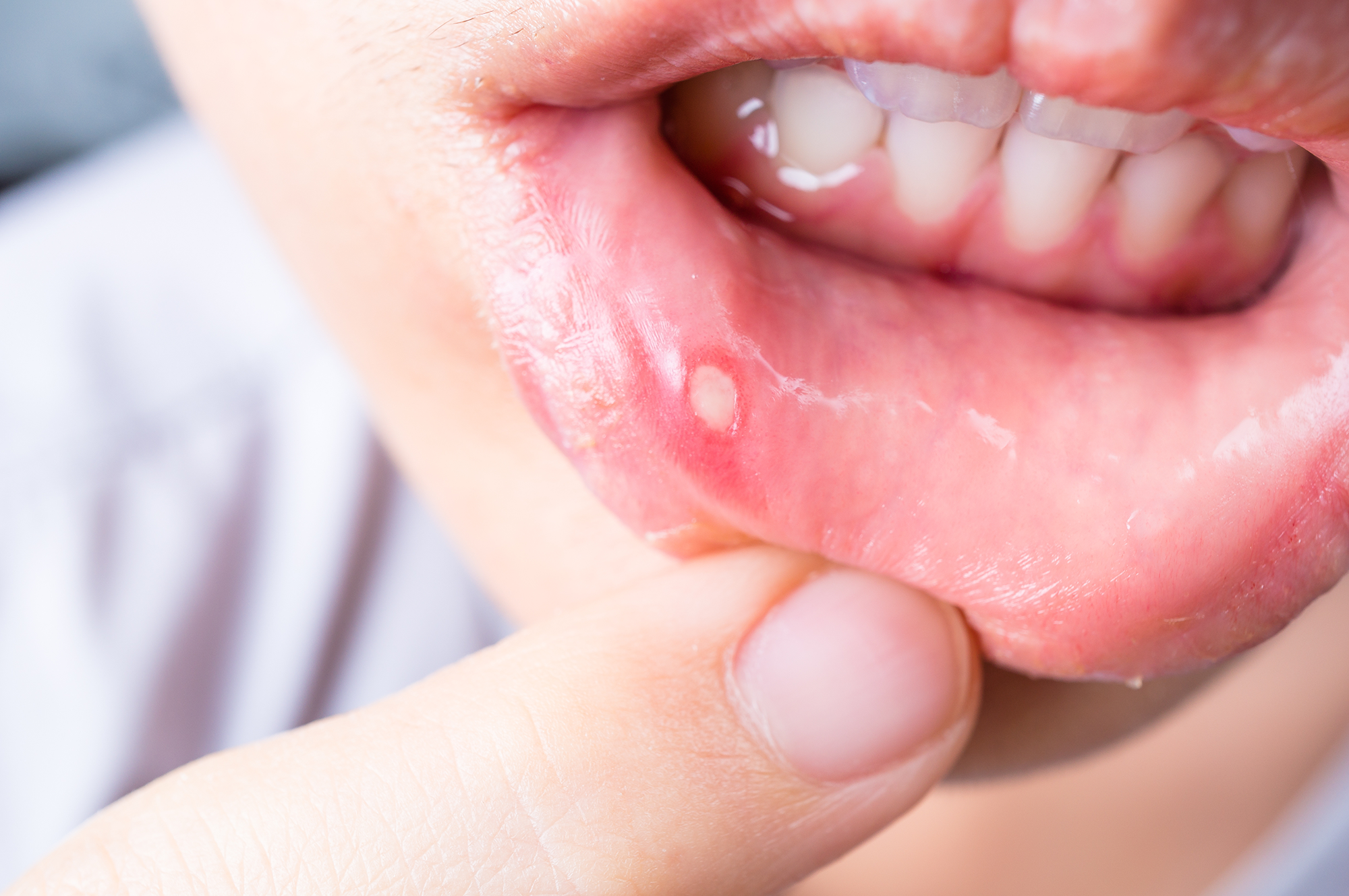 canker sore on soft palate